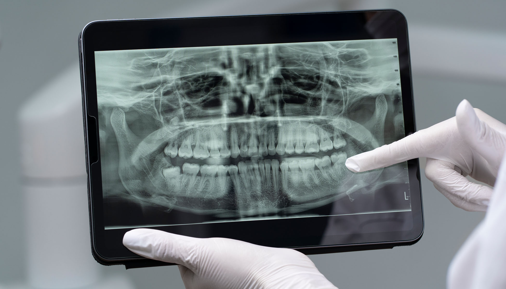 Effects of Smoking on Teeth and Gums Elfar Dental Belconnen Canberra