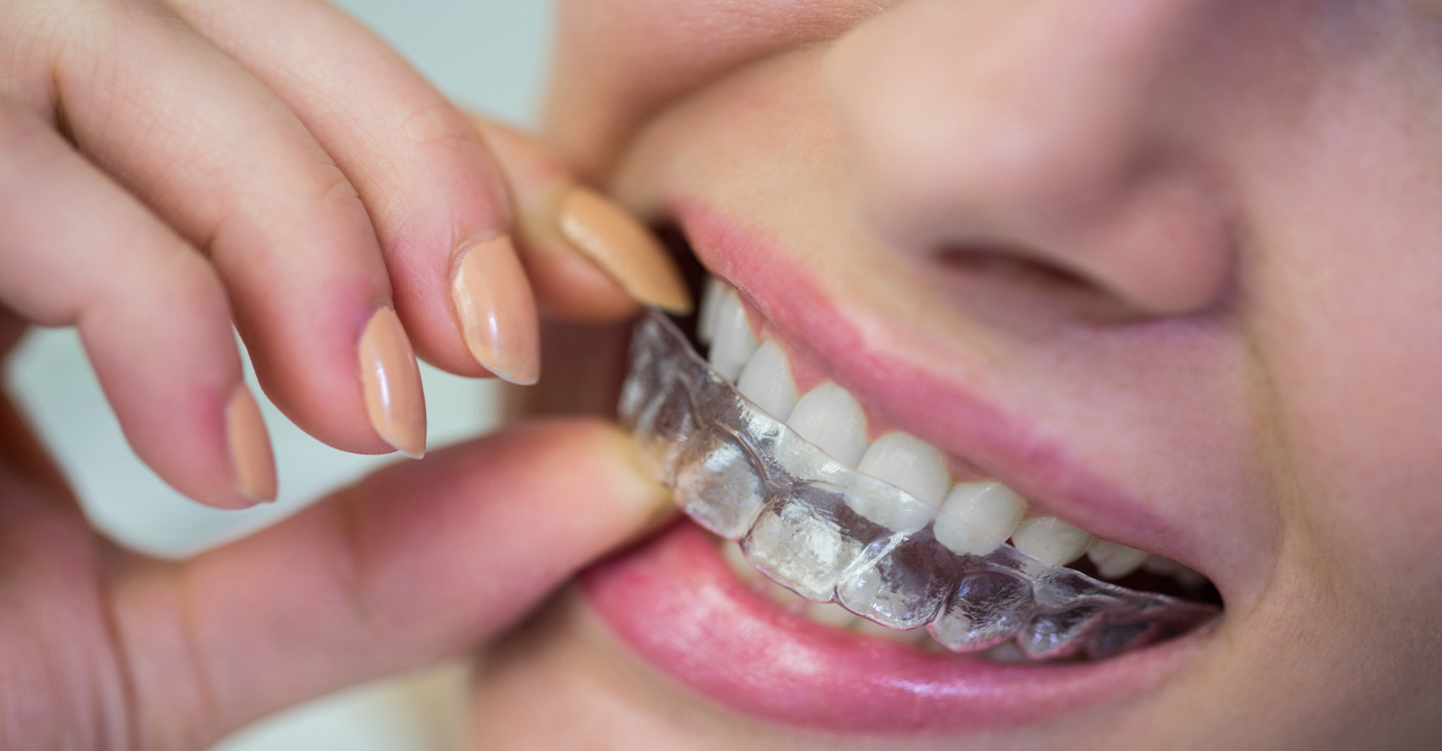 Cosmetic Dentistry Invisalign Elfar Dental Belconnen