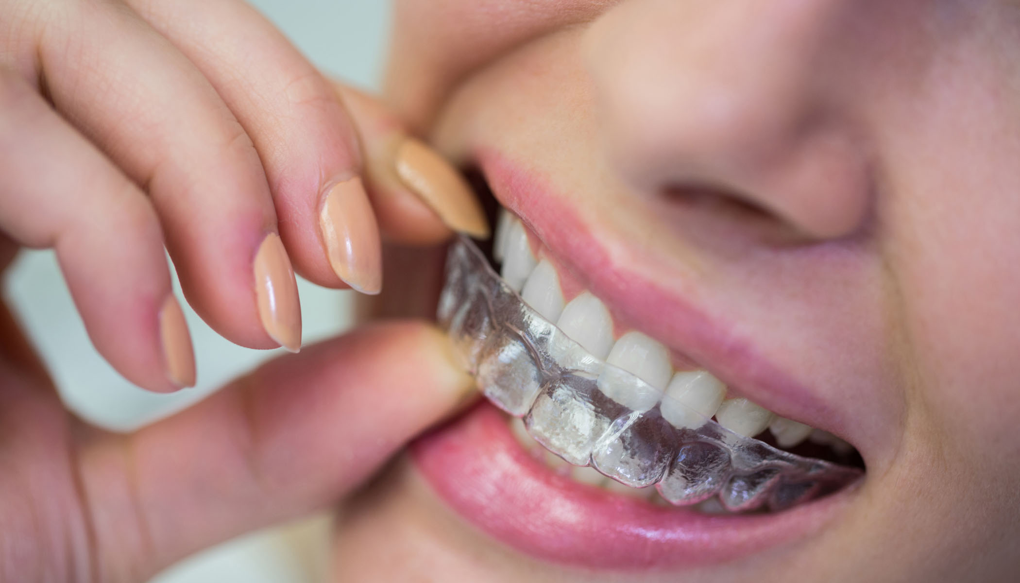 Cosmetic Dentistry Invisalign Elfar Dental Belconnen