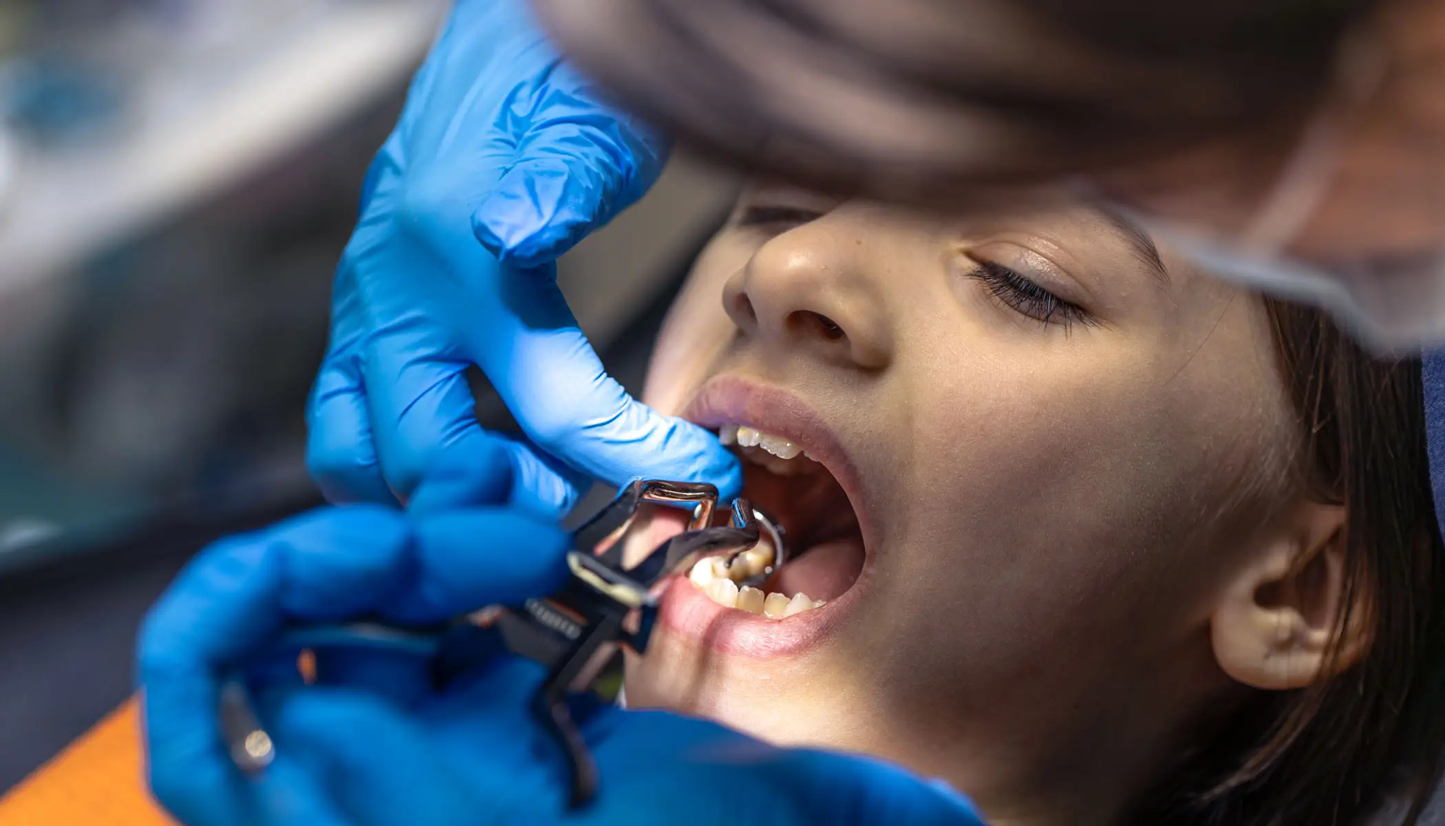 Dental Extractions Elfar Dental Belconnen Canberra