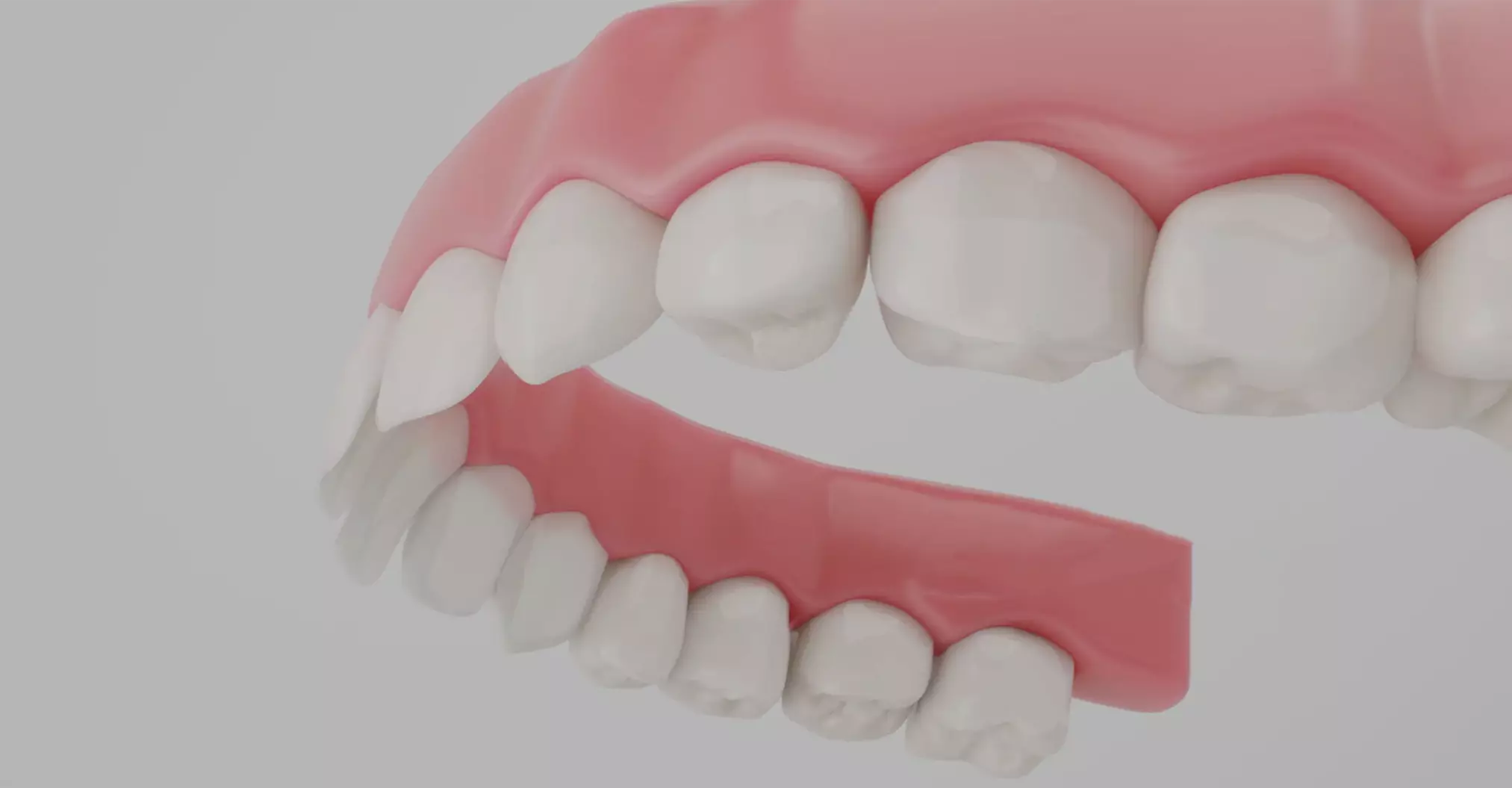 Full Arch Dental Implant Elfar Dental Belconnen