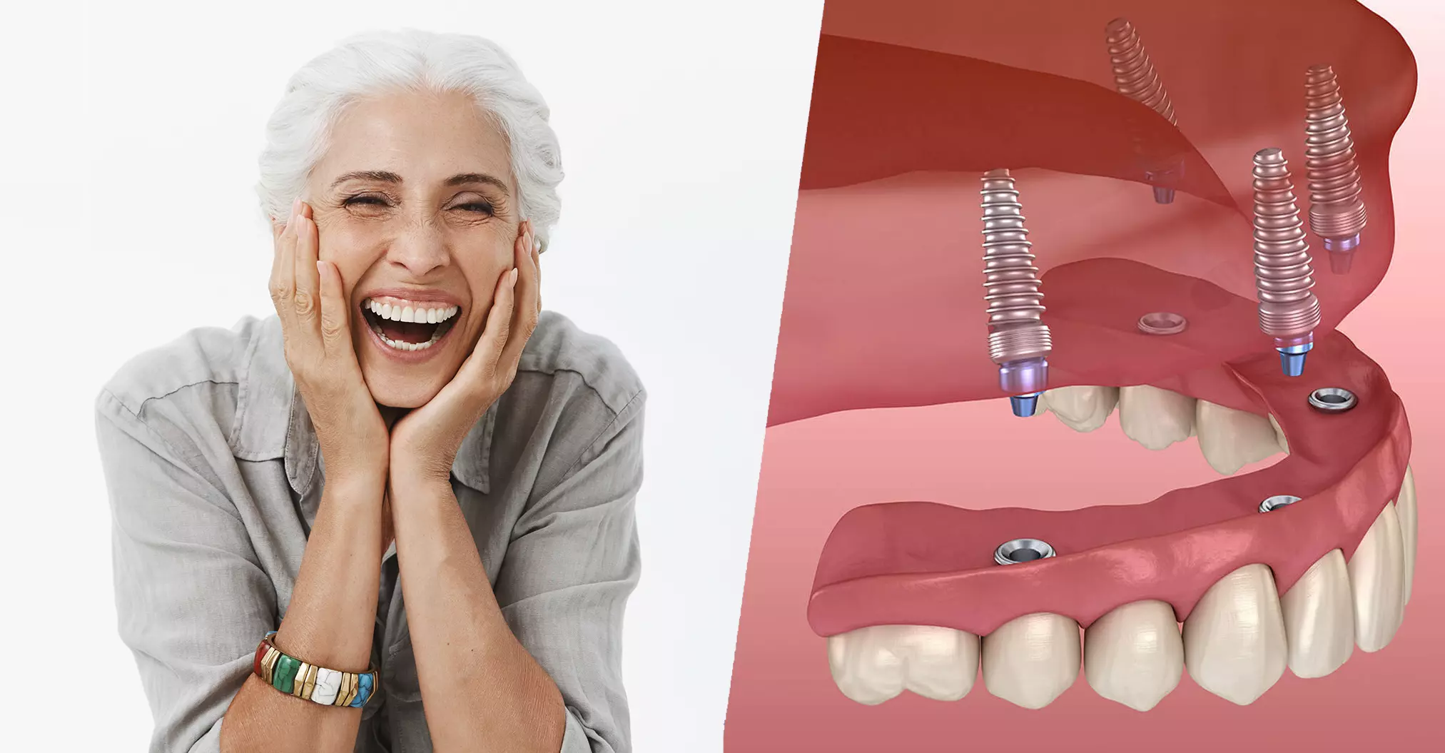 Full Arch Dental Implant Elfar Dental Belconnen