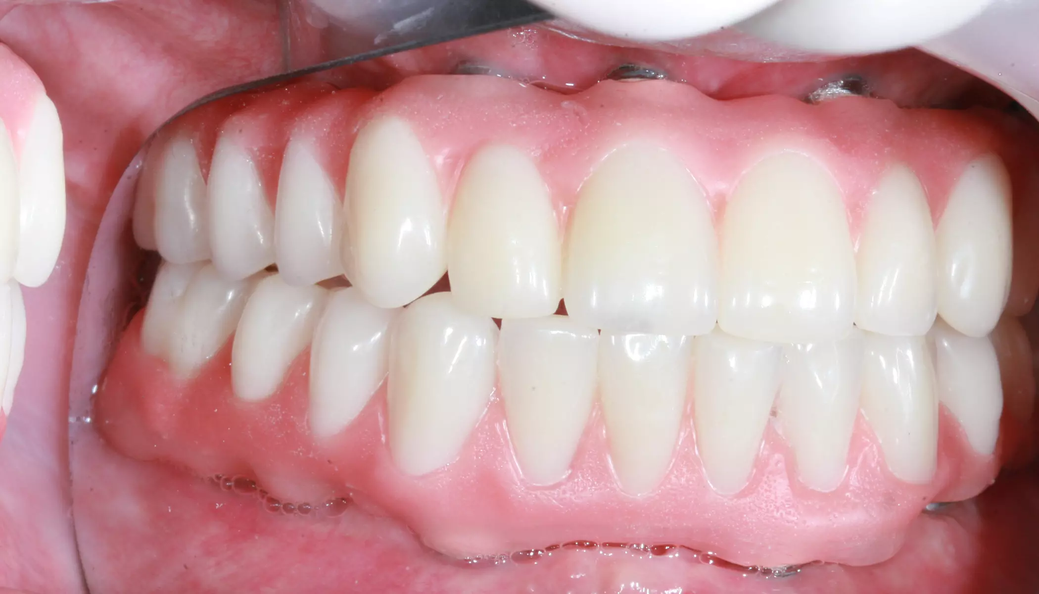 Full Arch Dental Implants Elfar Dental Belconnen