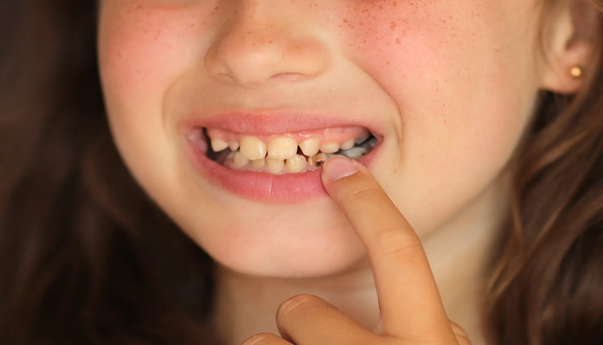 Children's Tooth Decay - Elfar Dental Belconnen Kids Dentist in Belconnen Canberra
