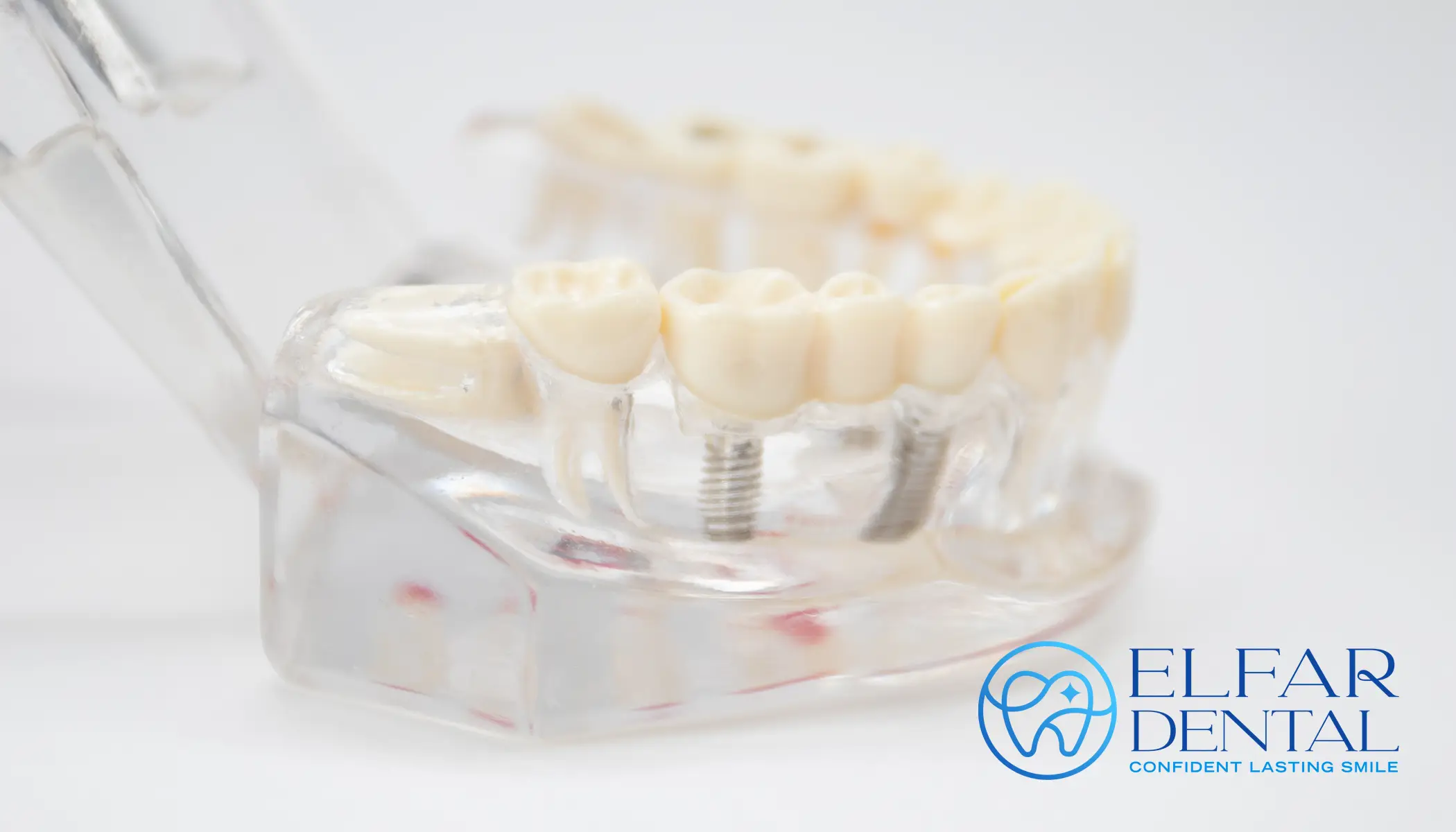 All-on-4 Dental Implants Belconnen Canberra - Elfar Dental Belconnen Dentist Canberra