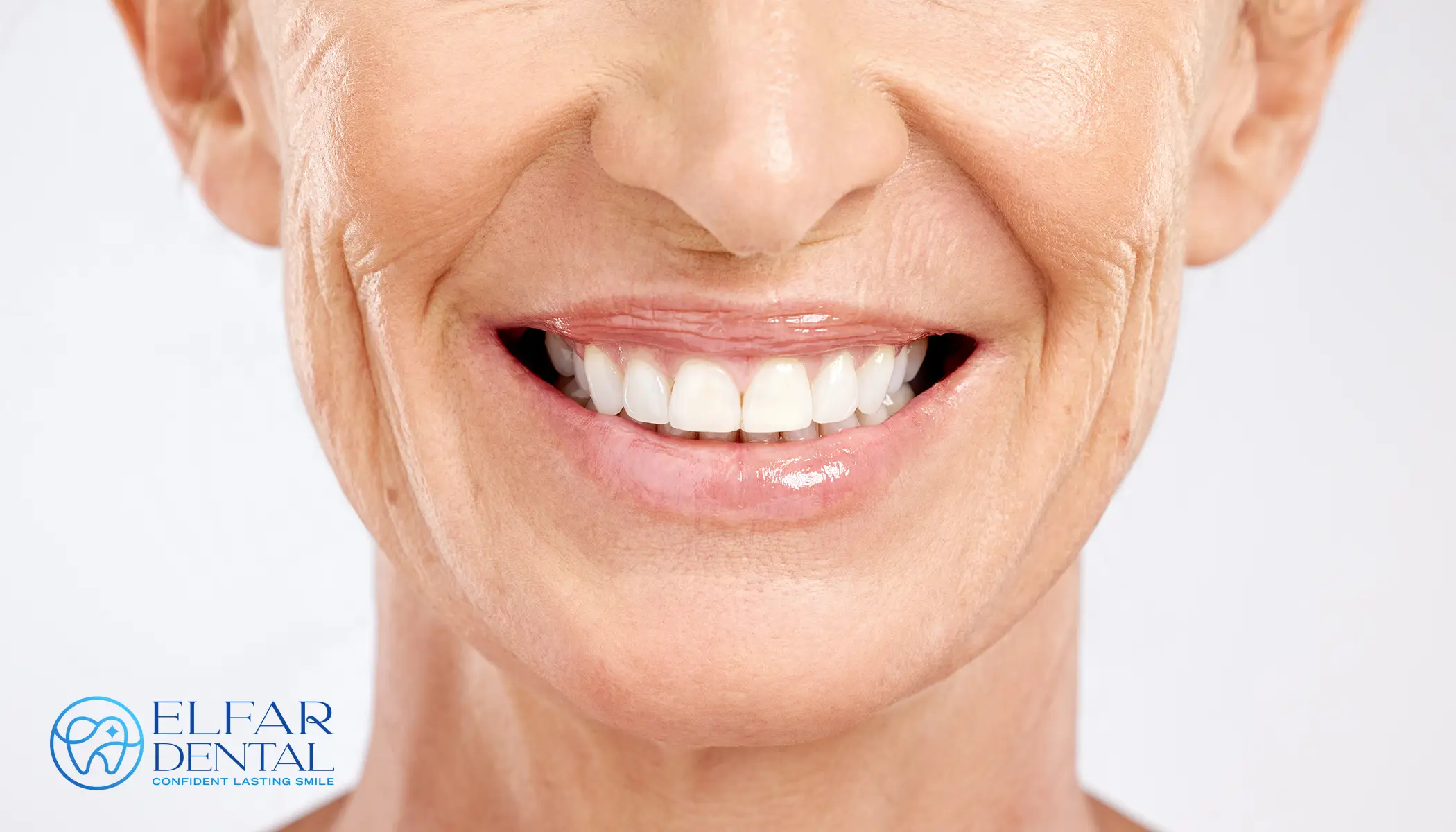 All on 4 Dental Implants Belconnen Canberra - Elfar Dental Belconnen Dentist Canberra