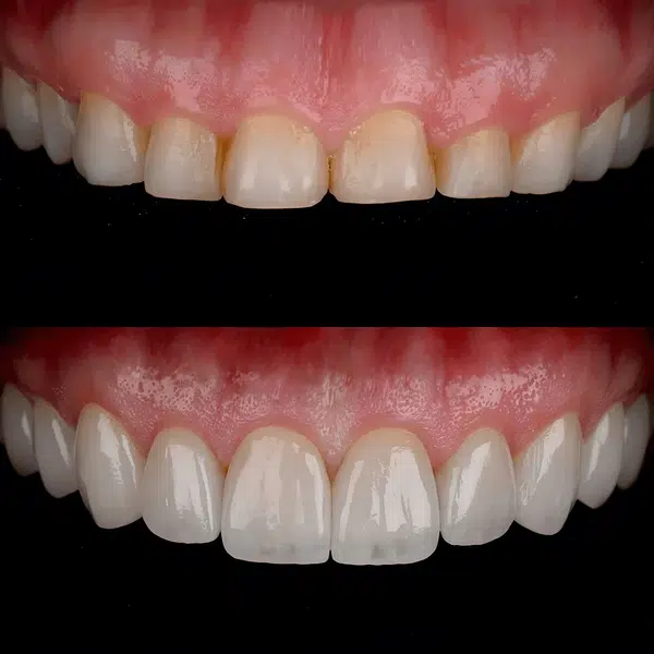 Dental Veneers Smile Makeover Cosmetic Dentistry Elfar Dental Belconnen Canberra ACT