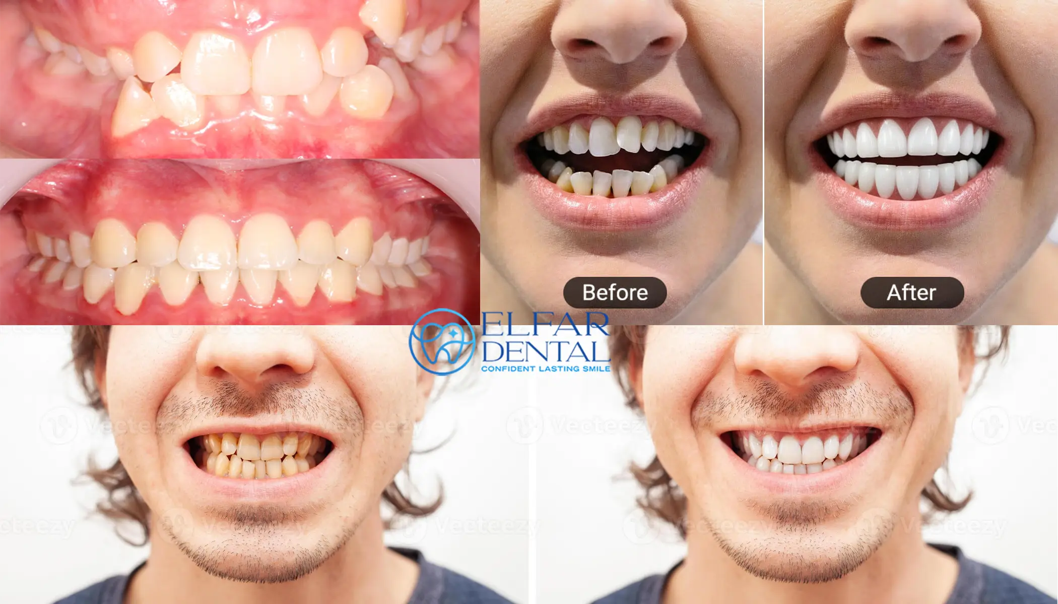 Smile Makeover Cosmetic Dentistry Belconnen - Elfar Dental Belconnen Dentist Canberra
