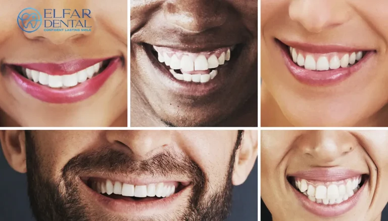 Natural Looking Veneers Smile Makeover Cosmetic Dentistry Elfar Dental Belconnen Canberra ACT