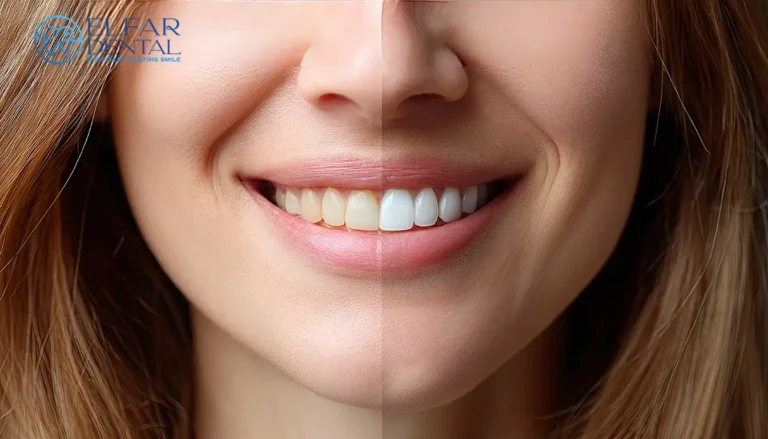 Teeth Whitening Dental Bonding Invisalign Smile Makeover Cosmetic Dentistry Dental Treatments Elfar Dental Belconnen Canberra ACT