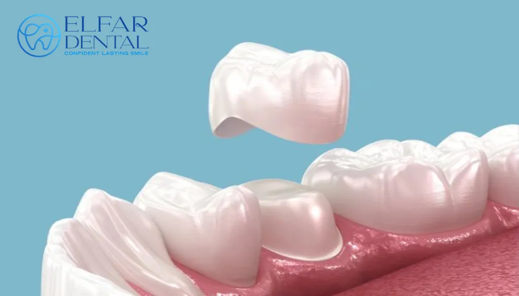Dental Crown Fell Out Lost Crown Emergency Dentist Elfar Dental Belconnen Canberra ACT