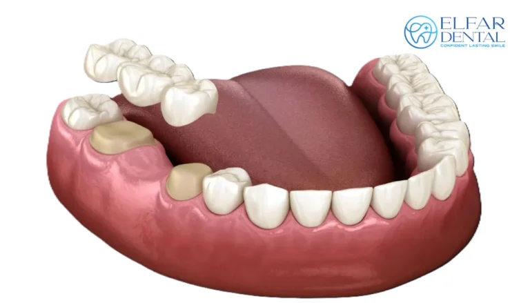 Tooth Replacement Options Dental Implants Dental Bridges Dentures Elfar Dental Belconnen Dentist Canberra