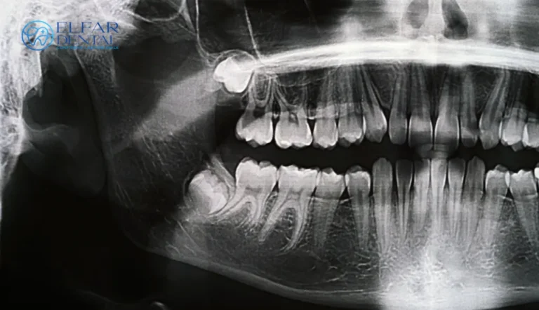 Tooth Extraction Belconnen- What to Expect Before Your Extraction- Elfar Dental Belconnen Dentists Canberra ACT