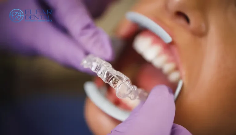Invisalign cost Belconnen Elfar Dental Canberra Dentists ACT
