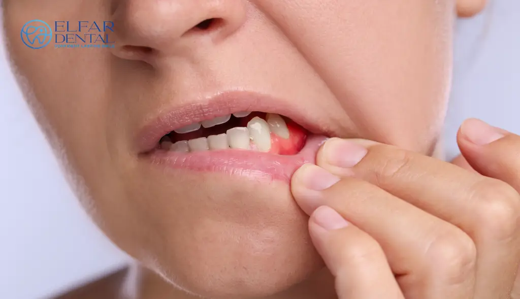 Dentist for Bleeding Gums Canberra - Elfar Dental Clinic Belconnen Dentists Canberra ACT