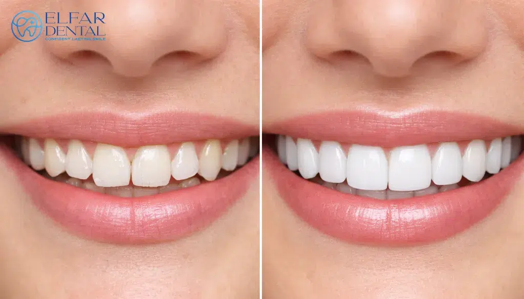 Veneers vs Natural Teeth Smile Makeover Cosmetic Dentistry Elfar Dental Belconnen Dentists Canberra ACT